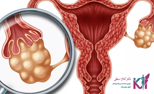 علل ابتلا توده های آدنکس