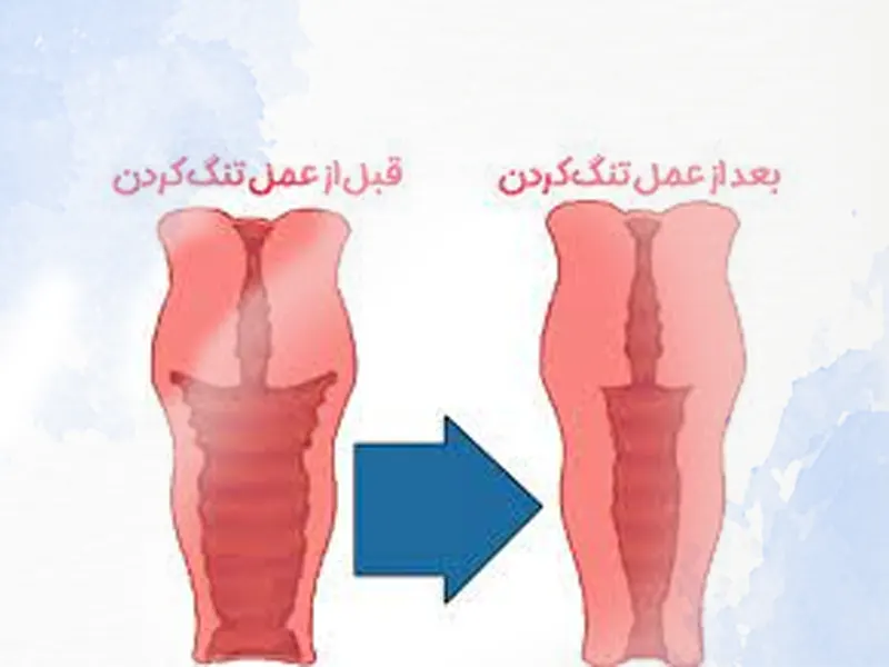 لیزر واژن بیکینی قبل و بعد