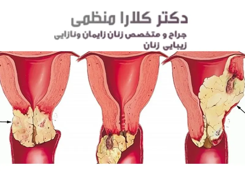 درمان سرطان دهانه رحم