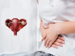 علت ایجاد کیست شکلاتی یا آندومتریوم