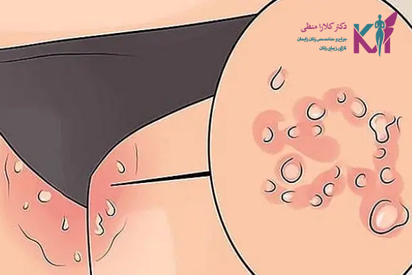 آیا زگیل تناسلی واگیر دارد؟