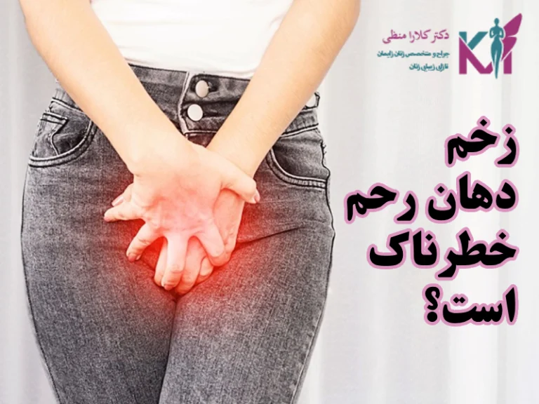 زخم دهانه رحم