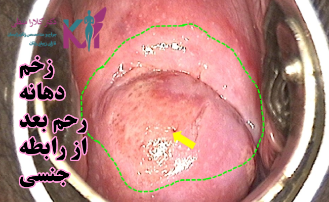 زخم دهانه رحم بعد از رابطه جنسی
