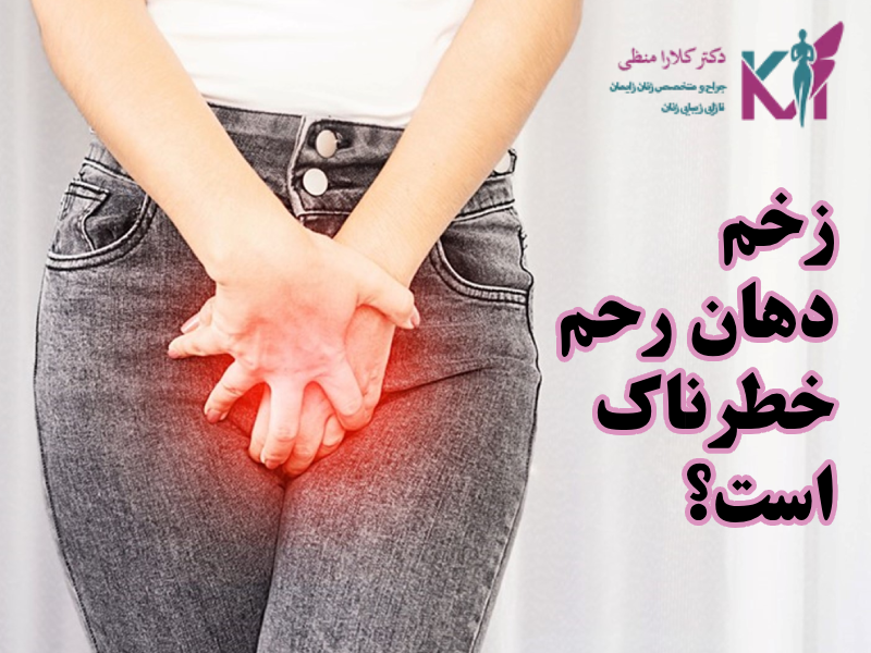 زخم دهانه رحم