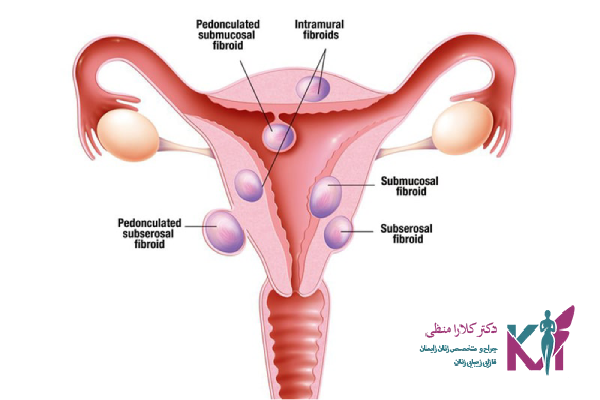خطرات جراحی برداشتن فیبروم رحم 