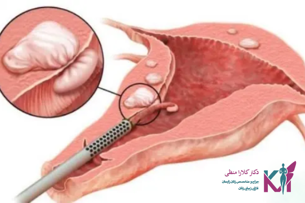 بهترین جراح فیبروم رحم در تبریز
