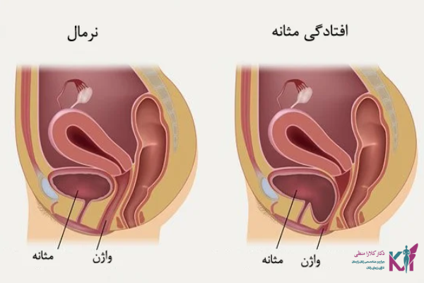افتادگی مثانه چیست؟