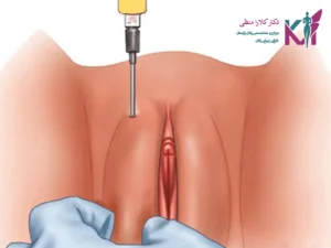تزریق چربی به واژن