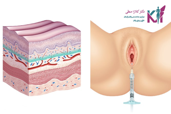 تزریق چربی به واژن چیست؟