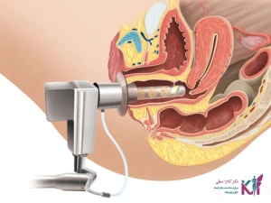 علت اصلی افتادگی مثانه در زنان چیست؟
