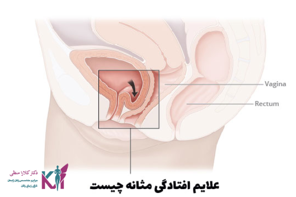 عوارض عدم درمان افتادگی مثانه