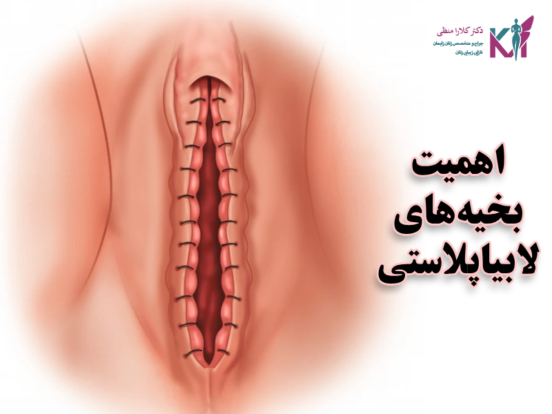 اهمیت بخیههای لابیاپلاستی