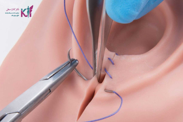 بخیه لابیاپلاستی چیست؟