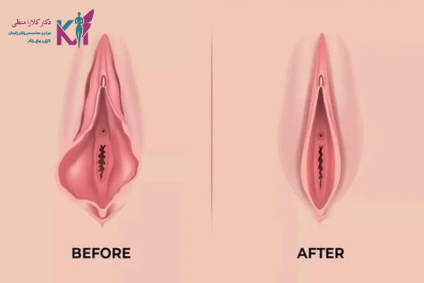 مزایای جسمی لابیاپلاستی