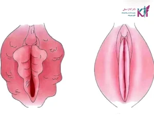 مزایای لابیاپلاستی چیست؟